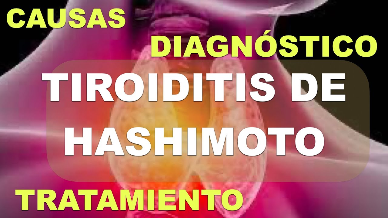 Tiroiditis de Hashimoto. Fisiopatología, Diagnóstico y Tratamiento.