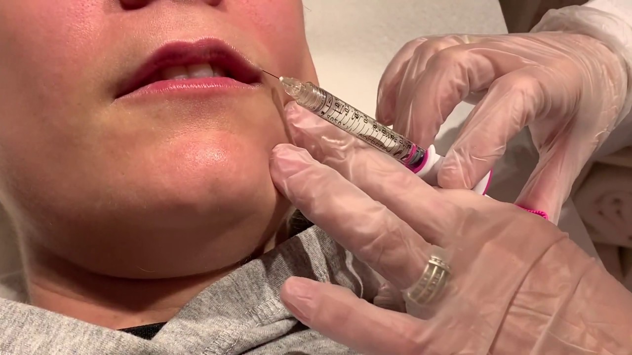 Aumento de labios con Ácido Hialurónico Juvederm Volbella | Dermaforyou by Dra Carmen Galera