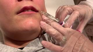 Aumento de labios con Ácido Hialurónico Juvederm Volbella | Dermaforyou by Dra Carmen Galera