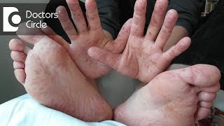 How to manage progressive red marks on hands? - Dr. Sachith Abraham