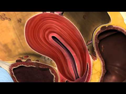 World Endometriosis Society's first Awareness film