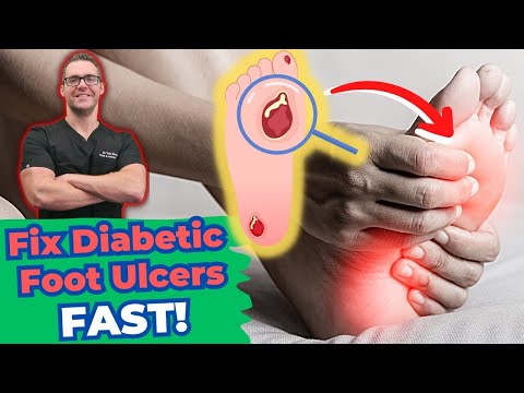 Diabetic Foot Ulcer Treatment & Early Stages [Diabetic Neuropathy]