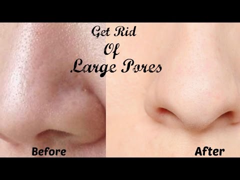 How to Get Rid of Large Pores in 7 Days || shrink large pores || Get Smooth, Fairer and Tighter Skin Video