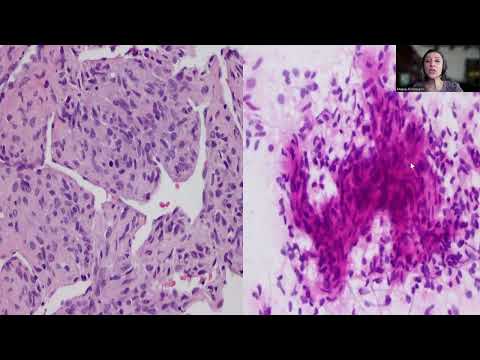 Tip-33; Solitary Fibrous Tumor of the Spine