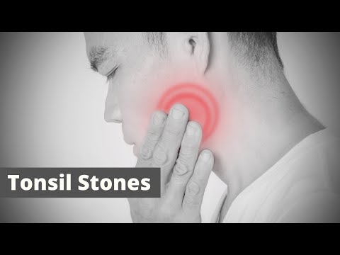 Tonsil Stones Meaning | Word pronounce | English Speaking | English | WordsClasses | #Shorts