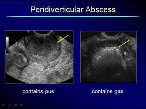 Non Gynecological Findings on Pelvic Scans 3