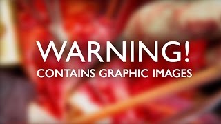 Edge of Death! Heart Aneurysm Operation - Back From The Dead - BBC