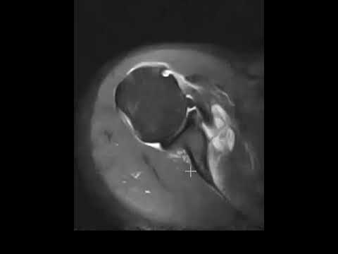 Subscapularis tendon rupture and dislocated biceps tendon
