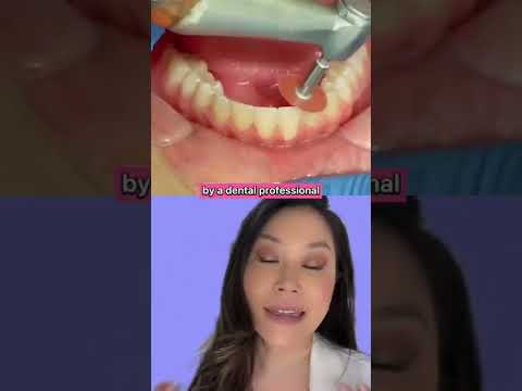 BTS Reshaping bumps on teeth (Mamelons) with Enameloplasty using Sanding Disc #mamelons