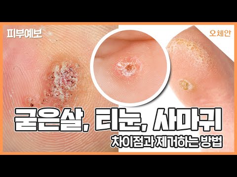 쥐젖 사마귀