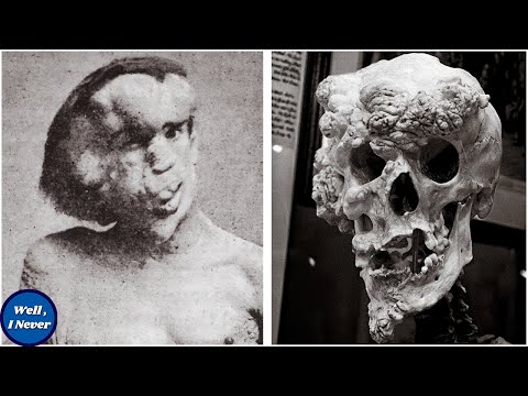 The Tragic Story of The 'Elephant man' Joseph Merrick | Well, I Never