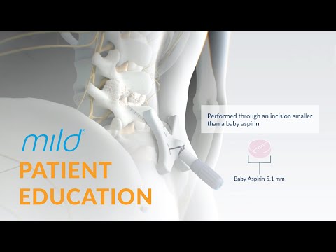 Mild Procedure Patient Education | Minimally Invasive Stenosis Treatment