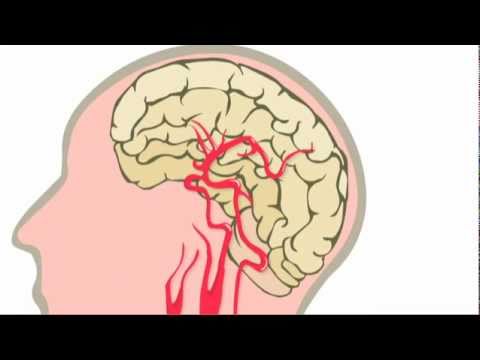 Wat is een beroerte?