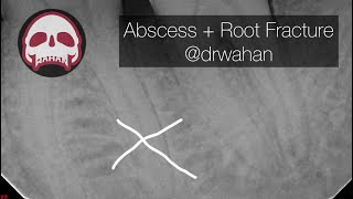 Dental Abscess Incision and Drain and Dental Extraction with Root Tip Fracture and Removal