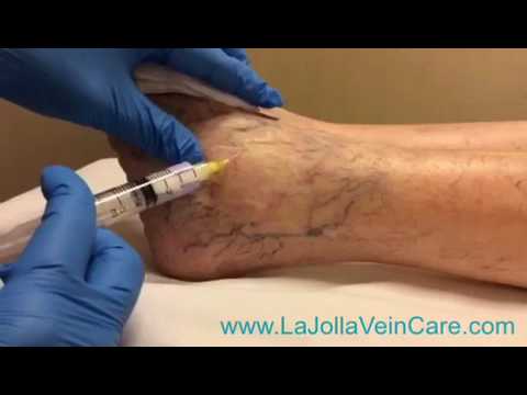 Durere varicoză în picior