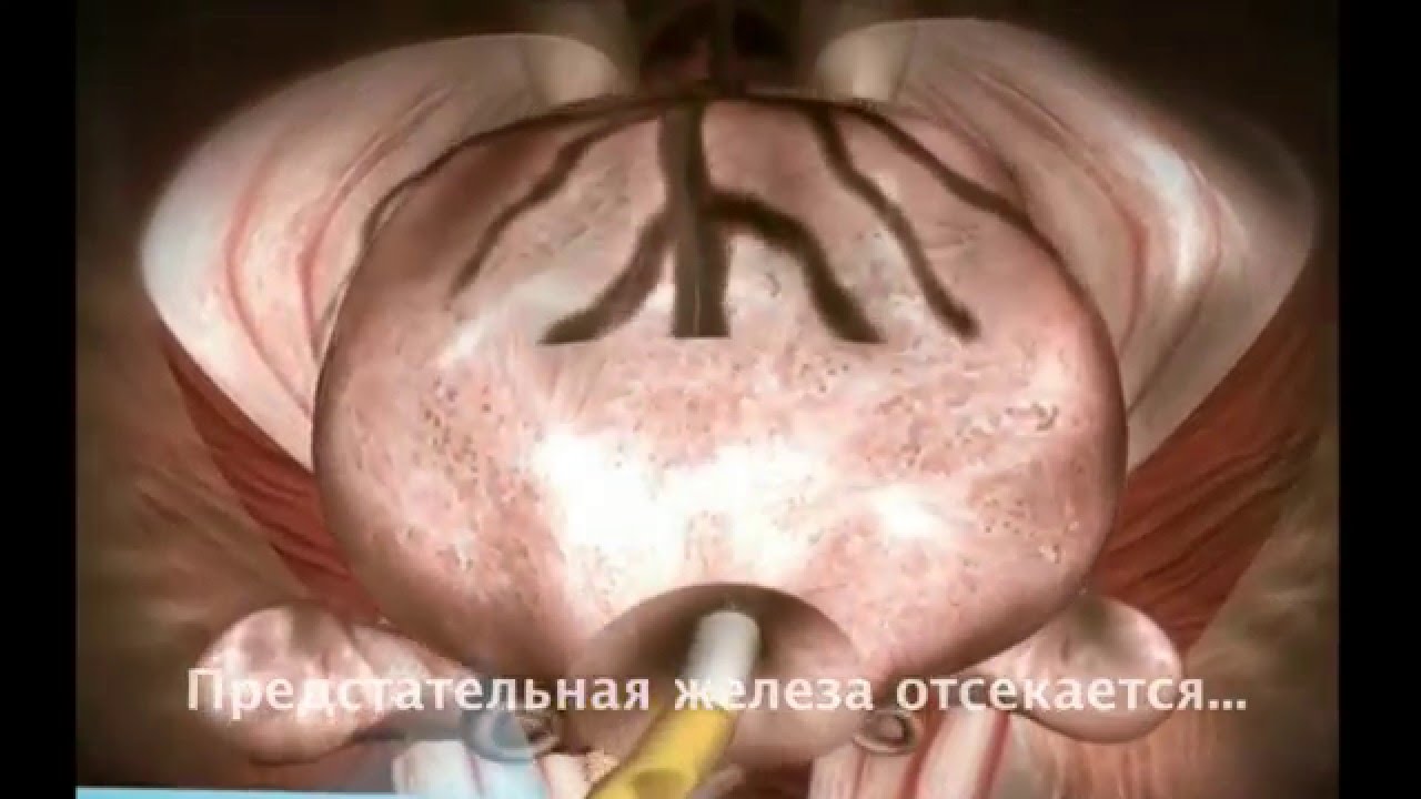 Превью видео на тему Эндоскопическая хирургия и лапароскопическая операция при варикоцеле