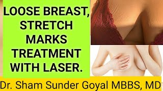 Loose Breast, Stretch Marks Treatment with Lasers.