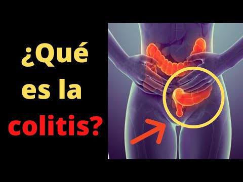 Síndrome de intestino irritable (colitis): criterios de ROMA