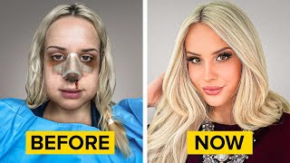 I was UGLY until I got the CHEAPEST NOSE JOB ($2,950) in a FOREIGN COUNTRY