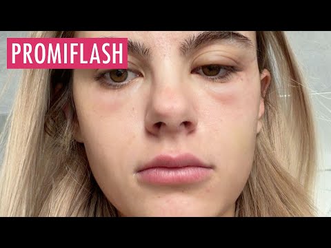 Video Thumbnail: Romina Palm leidet nach Beauty-Eingriff unter Schwellungen