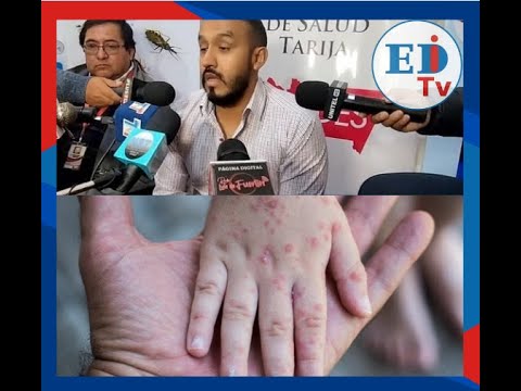 Alarma en Yacuiba: confirman segundo caso de sarampión en Tarija