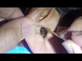 Hearing Loss due to Massive Earwax - Best Earwax Removal