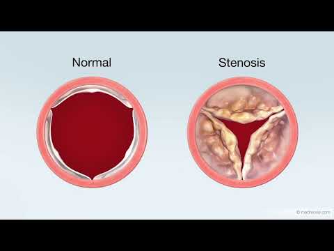Transcatheter Aortic Valve Replacement (TAVR) Treatment for Aortic Stenosis