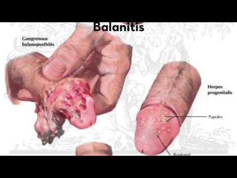 diabetes penis infection Audrey chaney porn