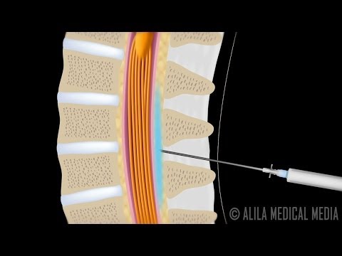 Lumbar Epidural Steroid Injection - Animation.