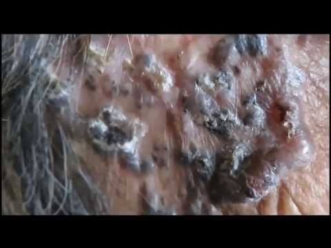Super Blackheads - Dilated Pores - Comedo Naevus
