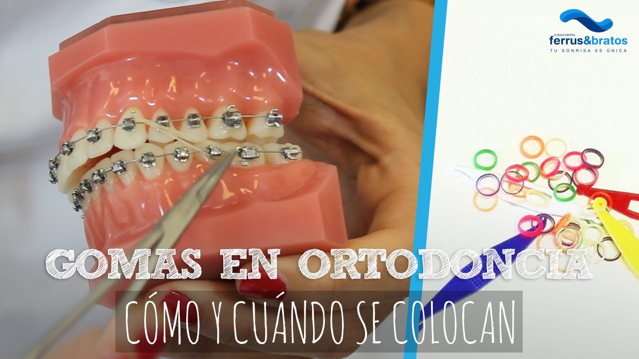 Gomas ortodoncia ¿Cómo y cuándo se colocan