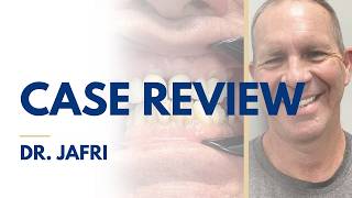 Stop the Cycle of Failing Dental Work Full Arch Implant Case Review