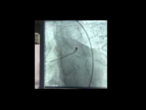 Left main-LAD-LCX bifurcation stenting