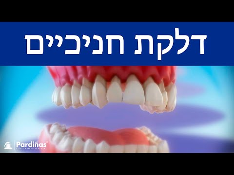 © דלקת חניכיים – מה זה