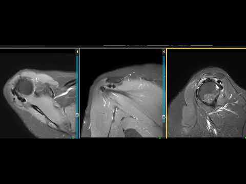 Calcific tendinitis of shoulder