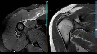 Pectoralis muscle and tendon tear