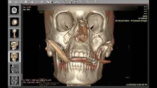 Facial and skull base fractures