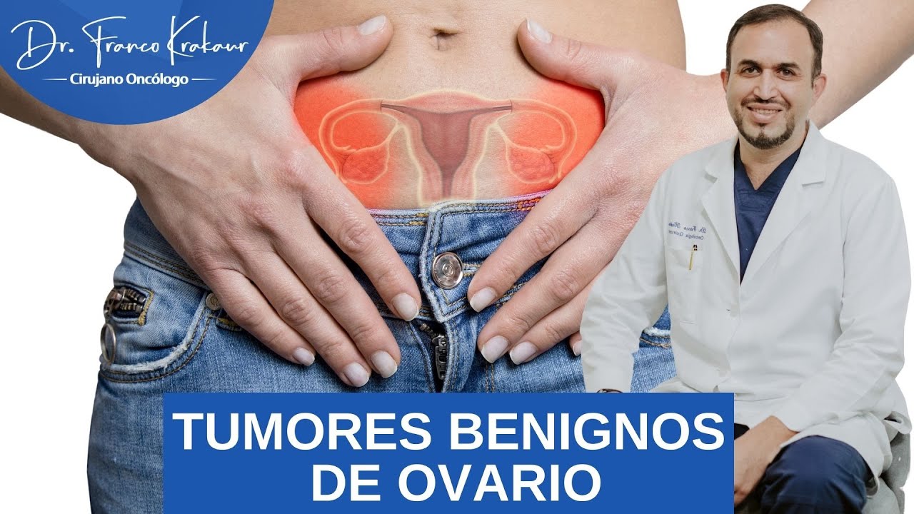 Tumores Benignos de Ovario/ Dr. Franco Krakaur/ Cirujano Oncólogo