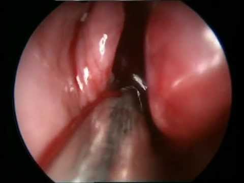légzési papillomatosis injekció pinworms cdc életciklus
