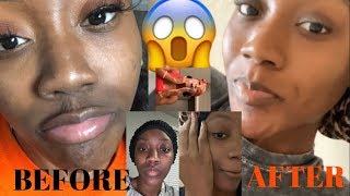 HOW TO GET RID OF HYPERPIGMENTATION&MELASMA FAST| EVEN SKIN TONE ROUTINE|I BLEACHED MY SKIN?!