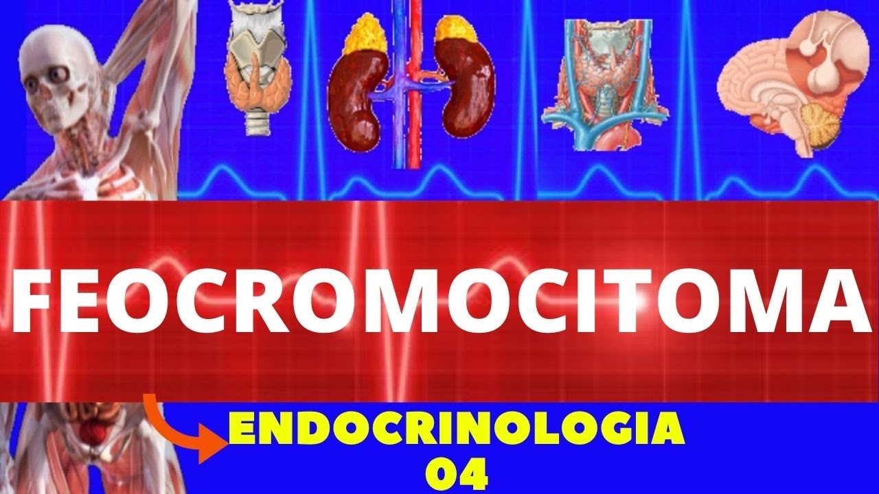 FEOCROMOCITOMA (TUMOR QUE CAUSA HIPERTENSÃO) - ENDOCRINOLOGIA