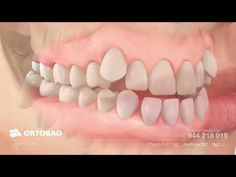 Carriere® Motion™ Appliance for Class III Correction 1