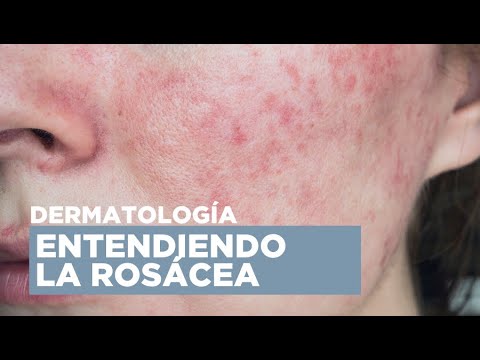 ROSÁCEA | ¿Qué es y cómo la tratamos?