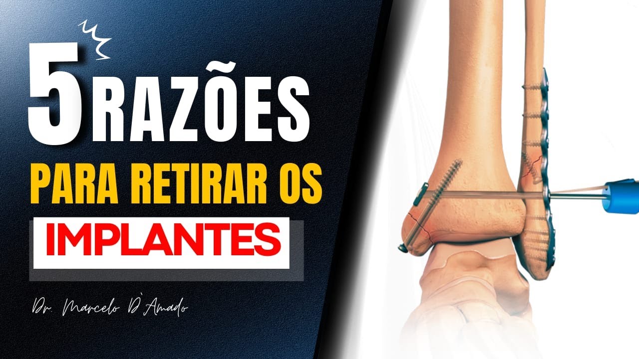 5 CASOS QUE VOCÊ DEVE RETIRAR A PLACA | PARAFUSO | HASTE| IMPLANTE - Cirurgia Ortopédica