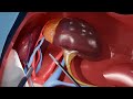 Chirurgia del Trapianto Renale: Fasi e Informazioni per il Paziente
