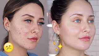 HOW TO GET RID OF ACNE SCARS + DARK SPOTS