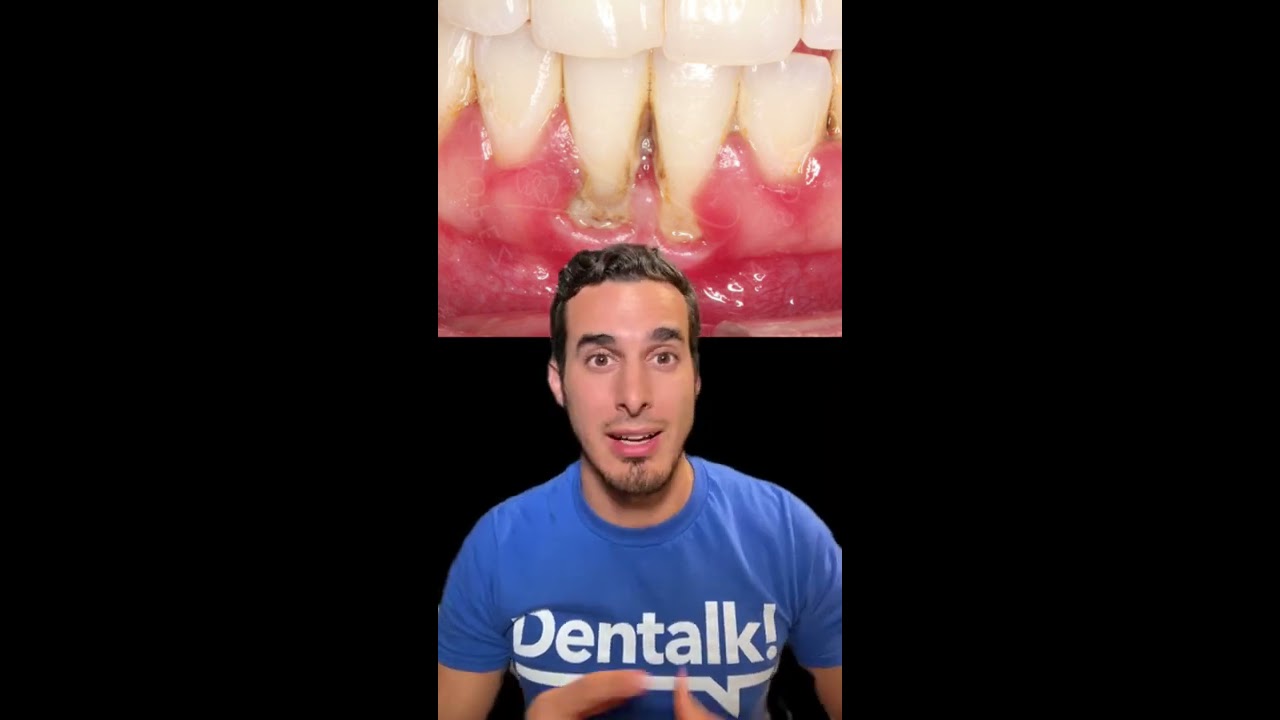Watch El SARRO DENTAL le bajó las ENCÍAS - Así se TRATA esta RECESIÓN Now El SARRO DENTAL le bajó las ENCÍAS - Así se TRATA esta RECESIÓN