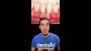 El SARRO DENTAL le bajó las ENCÍAS - Así se TRATA esta RECESIÓN