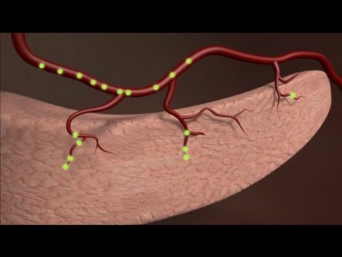 Le diabète, maladie du XXIè siècle