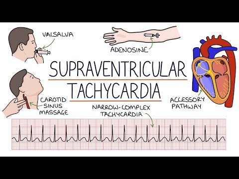 Understanding Supraventricular Tachycardia (SVT)